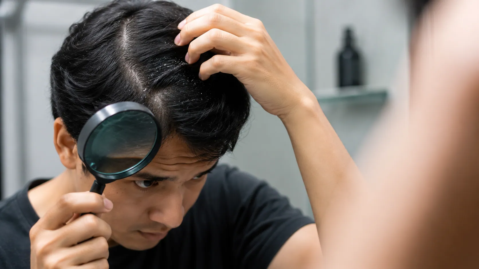 Can Dandruff Cause Hair Loss